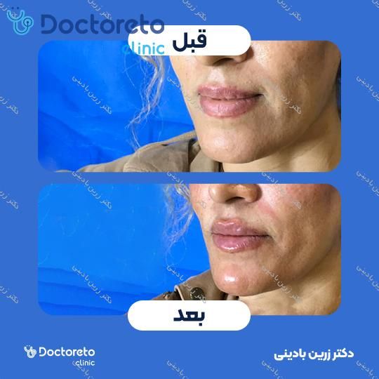 تزریق ژل لب با برند فیوریج (1cc)