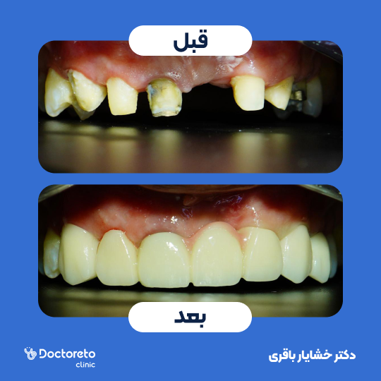 روکش دندان PFM (هر واحد)