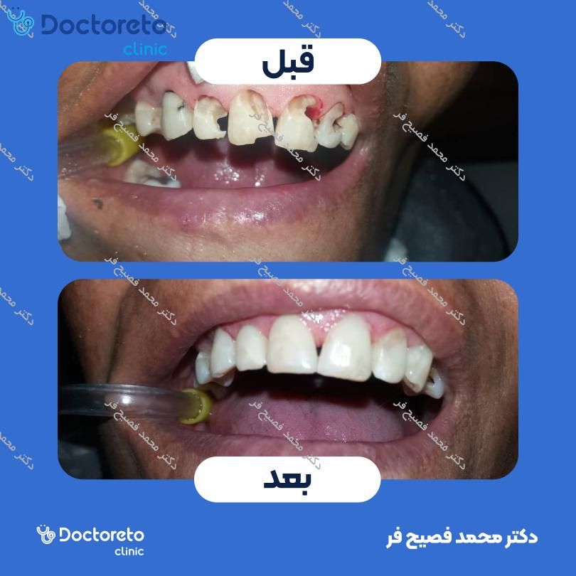 بیلداپ (بازسازی) دندان با کامپوزیت