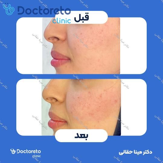 تزریق ژل گونه با برند نئوویا (1CC) دکتر مینا حقانی در اصفهان 12