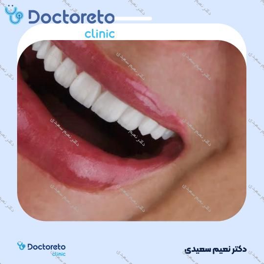 لمینت آی پی اس ایمکس (هر واحد)