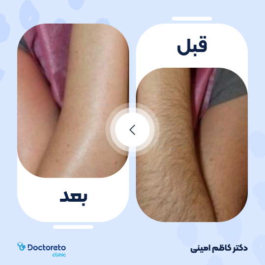 لیزر موهای زائد خانم ها (دست ها) با دستگاه جونولوکس کره ای