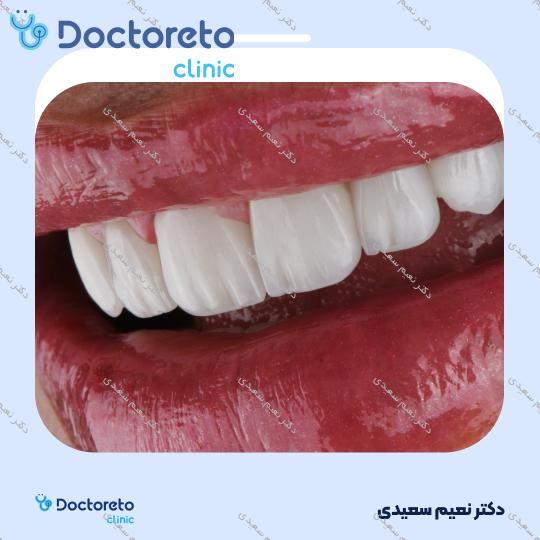 لمینت آی پی اس ایمکس (هر واحد)