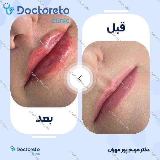 تزریق ژل لب با برند نورامیس (1cc) دکتر مریم پور مهران در شیراز 3