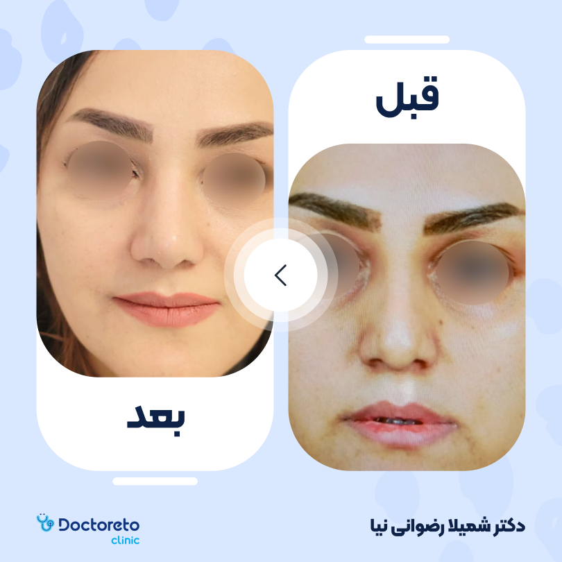 عمل زیبایی بینی گوشتی (رینوپلاستی) دکتر شمیلا رضوانی نیا در شیراز 5