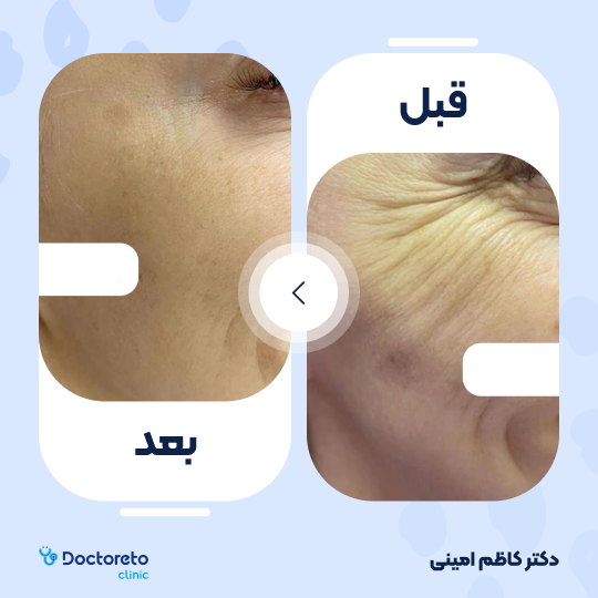تزریق بوتاکس صورت ( خطوط پنجه کلاغی) با برند مصپورت