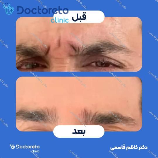 تزریق بوتاکس پیشانی با برند دیستون