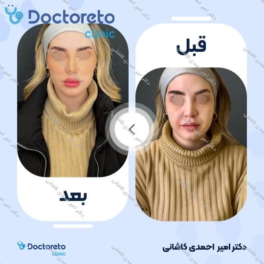 تزریق ژل زاویه فک با برند الانسه (1cc)