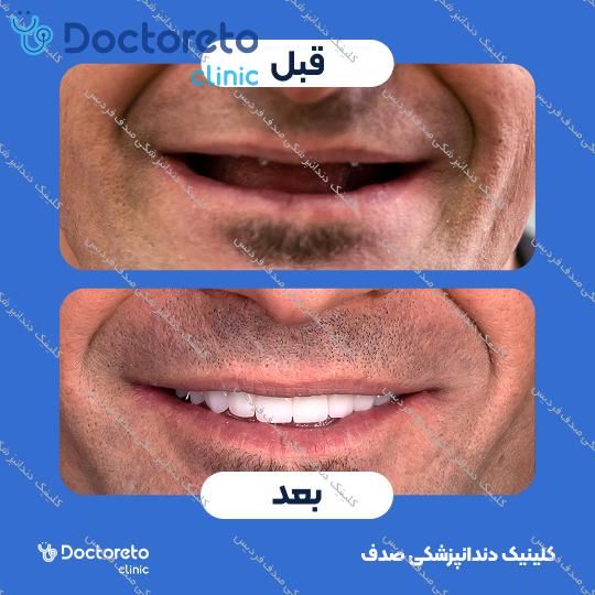 ایمپلنت core1 کره ای با روکش (هر واحد)