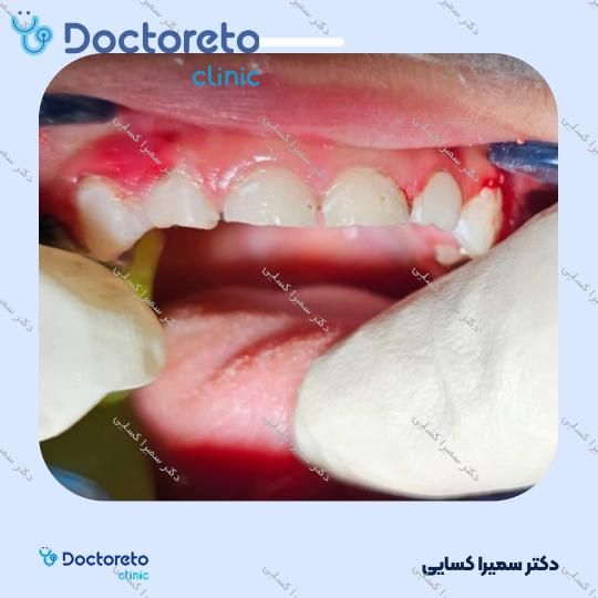 پرکردن دندان با کامپوزیت ( اطفال )