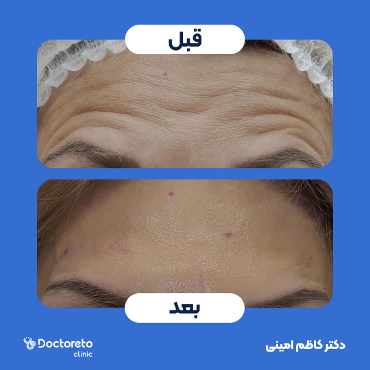 تزریق بوتاکس صورت (پیشانی) با برند مصپورت