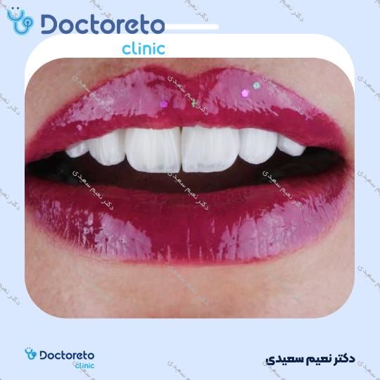 لمینت آی پی اس ایمکس (هر واحد)