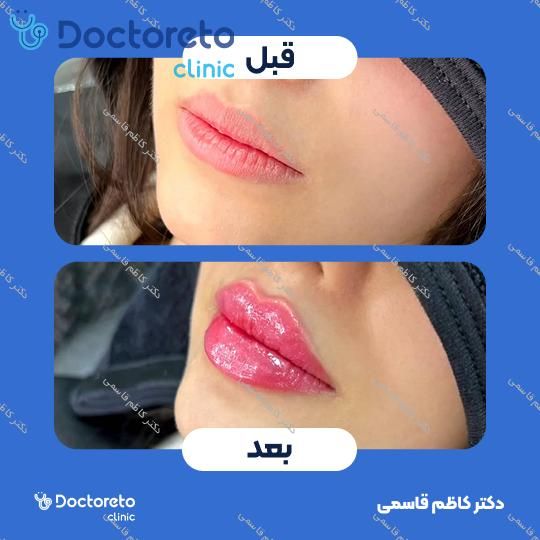 تزریق ژل لب با برند اینووسنس (1cc)