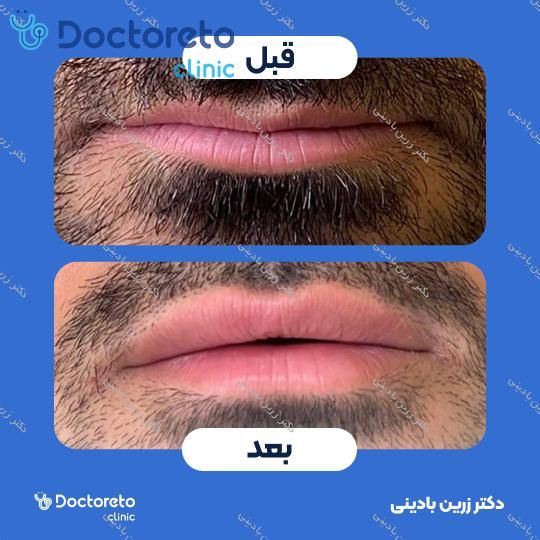 تزریق ژل لب با برند فیوریج (1cc)
