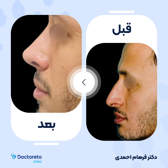 عمل جراحی مجدد زیبایی بینی (رینوپلاستی)