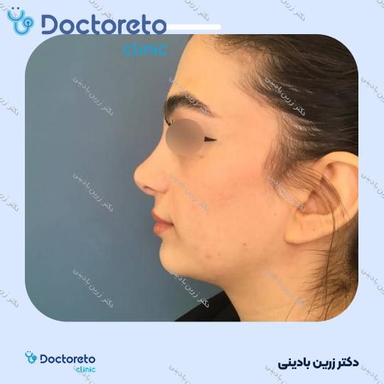 تزریق ژل چانه با برند فیوریج (1cc)
