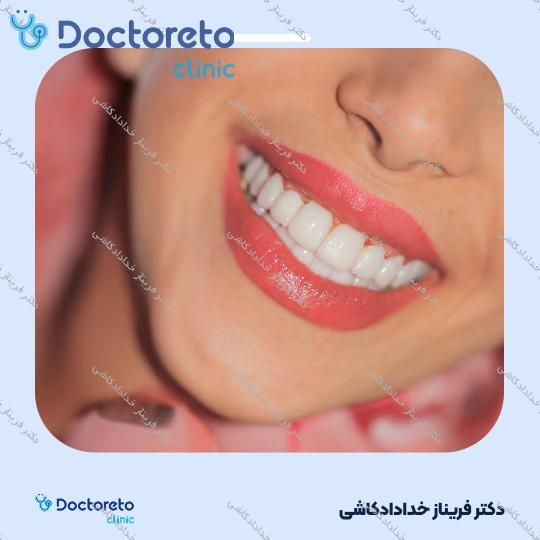 لمینت سرامیکی ایمکس vip (هر واحد)