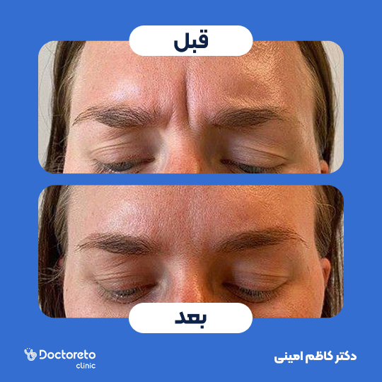 تزریق بوتاکس صورت (خط اخم) با برند مصپورت