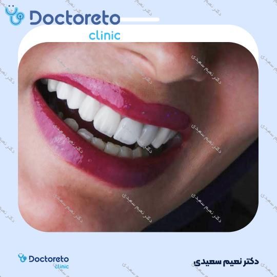 لمینت آی پی اس ایمکس (هر واحد)