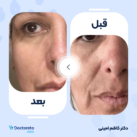 جوانسازی صورت با اگزوزوم تراپی و پلاسماتراپی (هر جلسه)