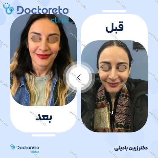 بوتاکس صورت (پیشانی، پنجه کلاغی، خط اخم) با برند مصپورت