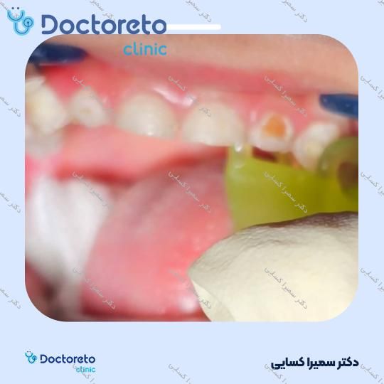 پرکردن دندان با آمالگام ( اطفال )