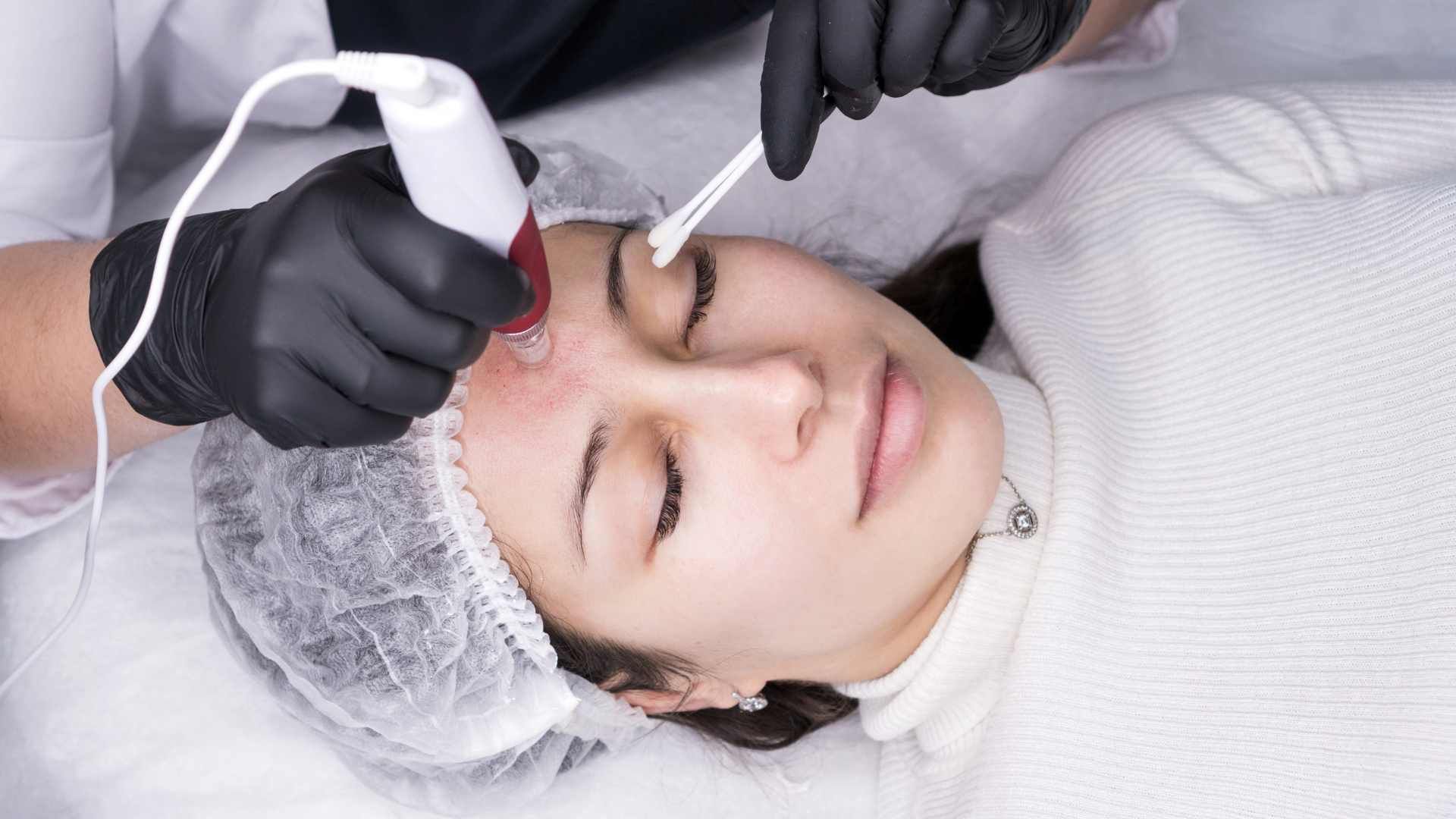 جوانسازی صورت با مزوتراپی فیوژن (هر جلسه)