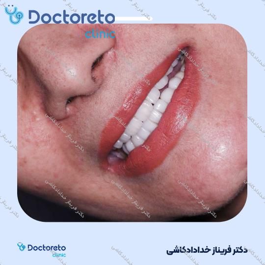 لمینت سرامیکی ایمکس آلمان به همراه تکسچر (هر واحد)