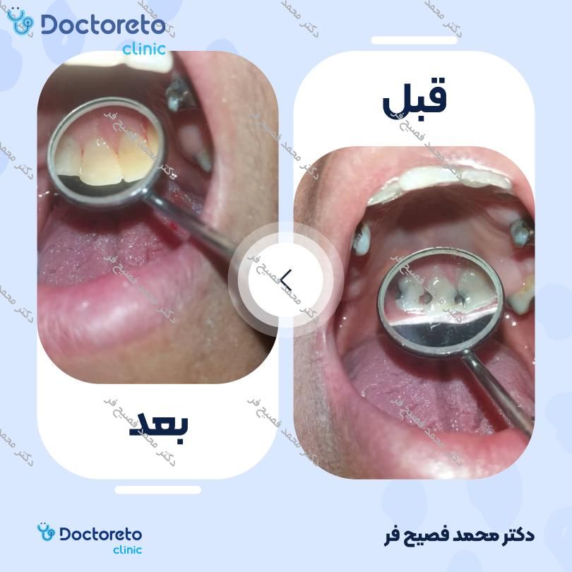 پرکردن دندان 1 سطحی با کامپوزیت