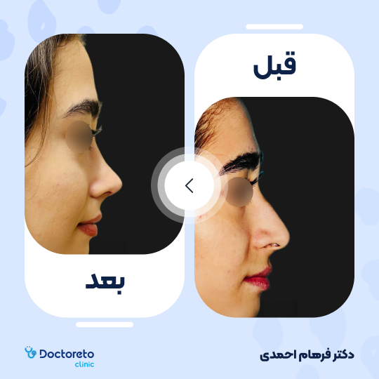 عمل زیبایی بینی (رینوپلاستی)