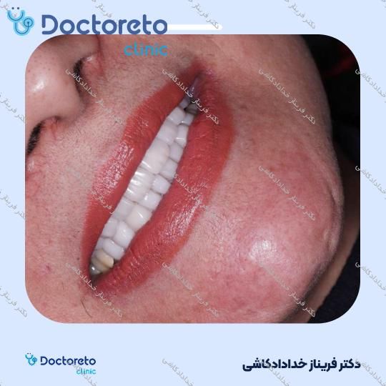 لمینت سرامیکی (هر واحد)