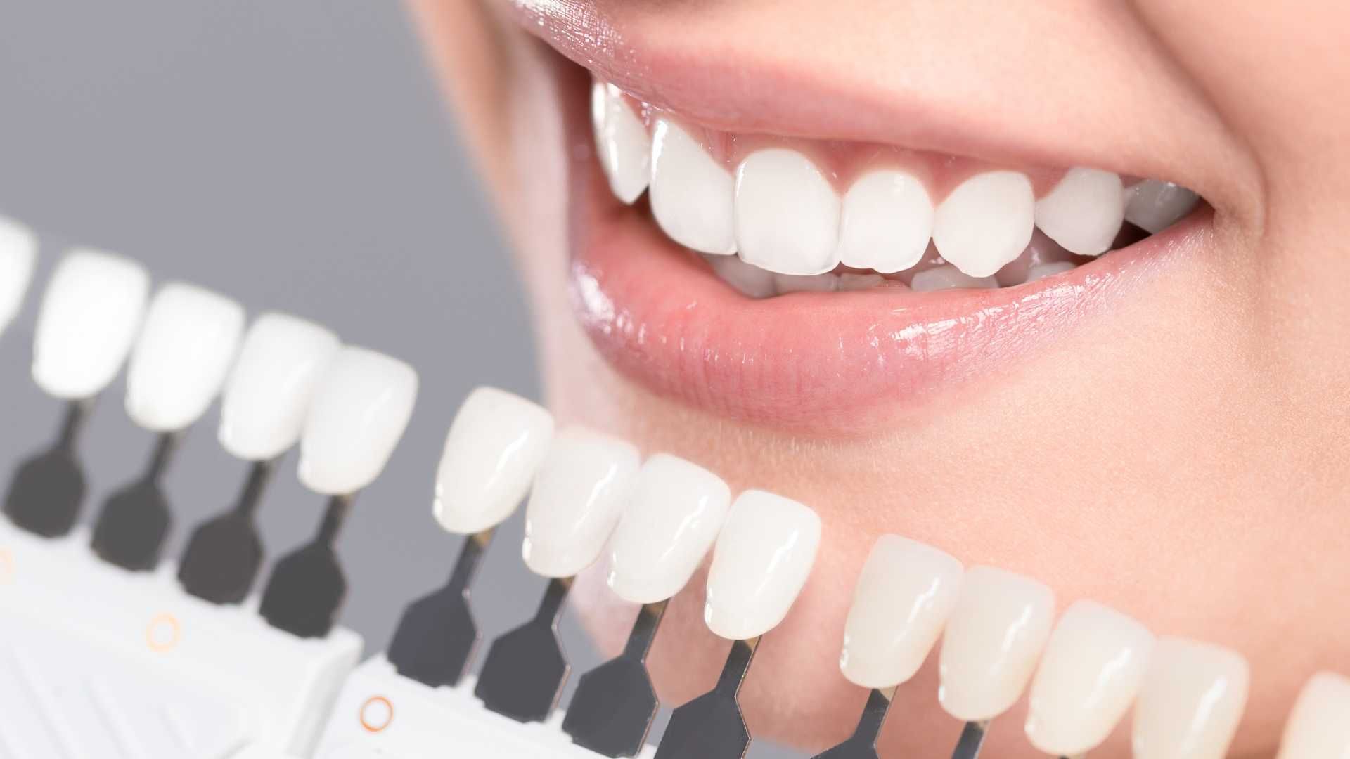 روکش تمام سرامیک زیرکونیا (هر واحد)