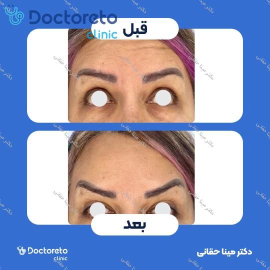 تزریق بوتاکس صورت (پیشانی، خط اخم، پنجه کلاغی) با برند مصپورت دکتر مینا حقانی در اصفهان 11