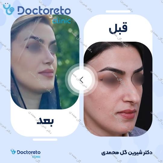 عمل جراحی مجدد زیبایی بینی (رینوپلاستی)