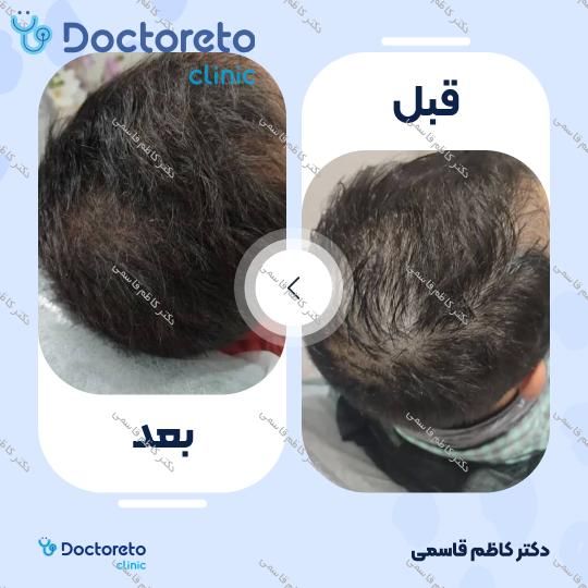 مزوتراپی مو سر با برند هیرکر فرانسه (هر جلسه)