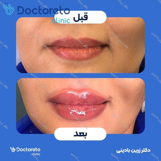 تزریق ژل لب با برند فیوریج (1cc)