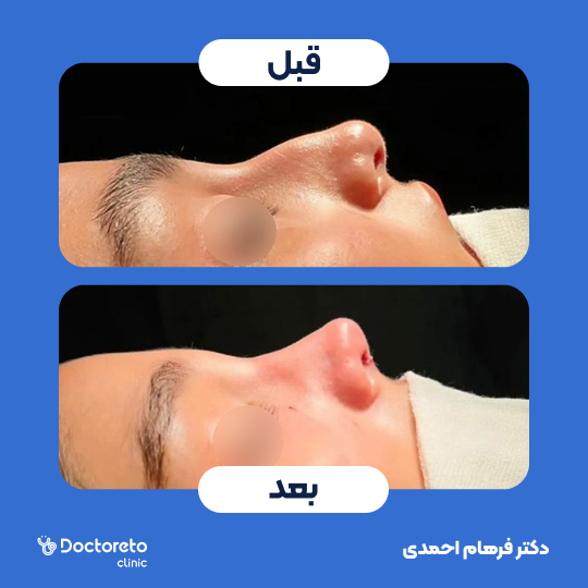 عمل جراحی مجدد زیبایی بینی (رینوپلاستی)