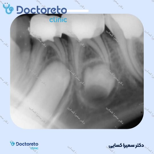 پالپکتومی دندان شیری (هر دندان)