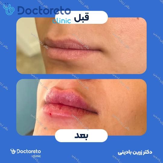 تزریق ژل لب با برند فیوریج (1cc)