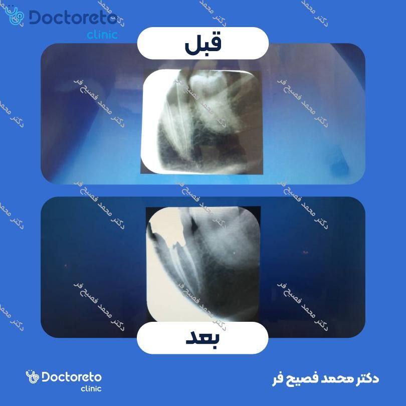 بیلداپ (بازسازی) دندان با آمالگام