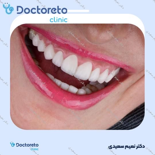 لمینت آی پی اس ایمکس (هر واحد)