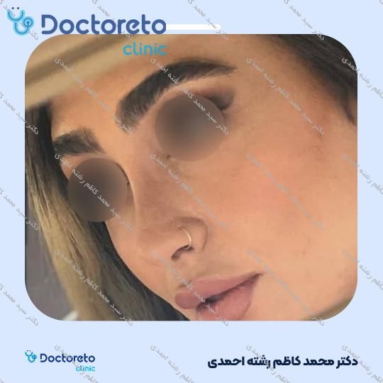 عمل زیبایی بینی (رینوپلاستی)