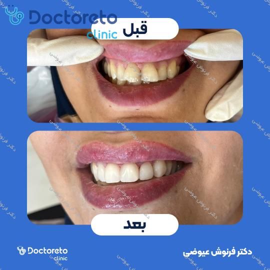 آفیس بلیچینگ دو فک با ماده SGN دکتر فرنوش عیوضی در تهران 2