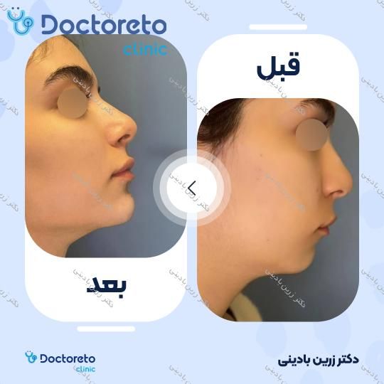 تزریق ژل چانه با برند فیوریج (1cc)