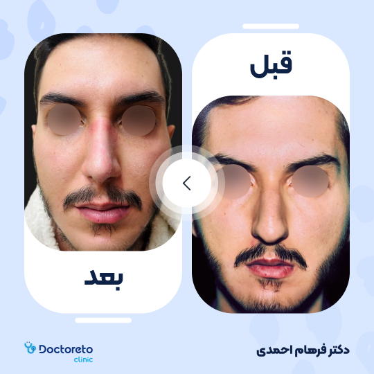 عمل زیبایی بینی (رینوپلاستی)