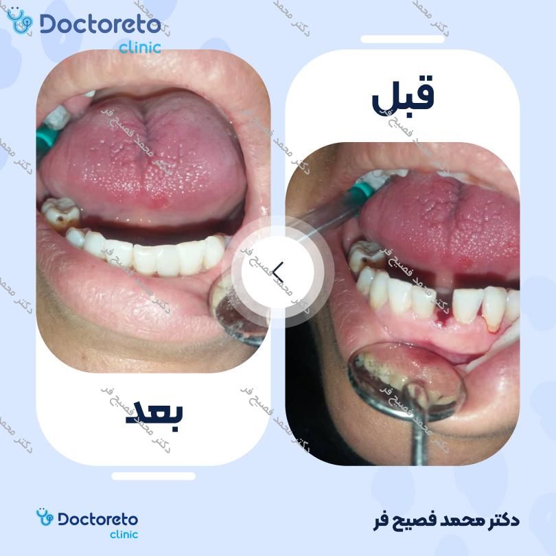 پرکردن دندان 2 سطحی با کامپوزیت