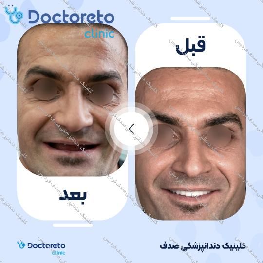 ایمپلنت core1 کره ای با روکش (هر واحد)
