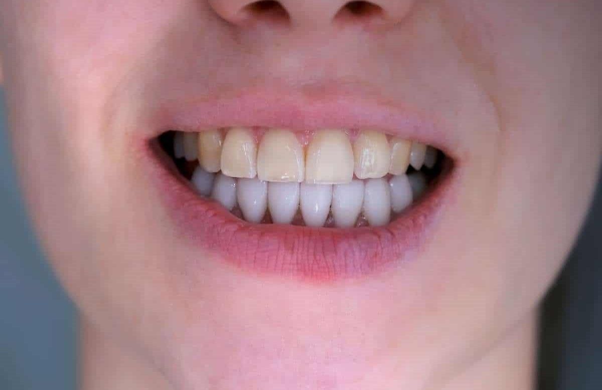 ونیر کامپوزیت سارمکو (هر واحد)