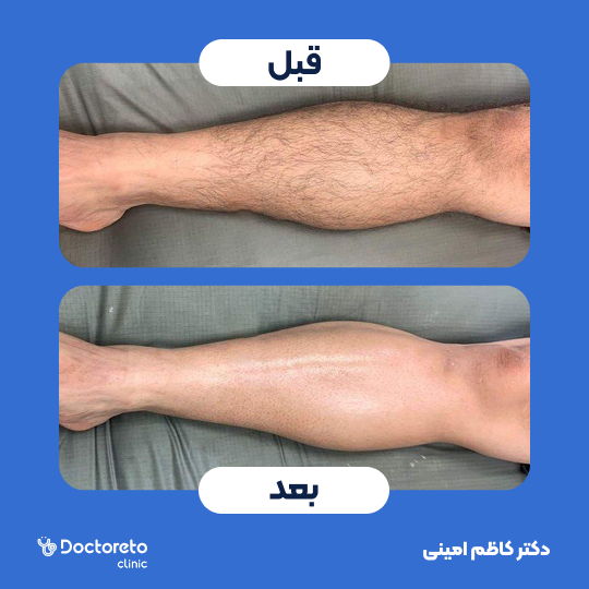 لیزر موهای زائد خانم ها (پا ها) با دستگاه جونولوکس کره ای