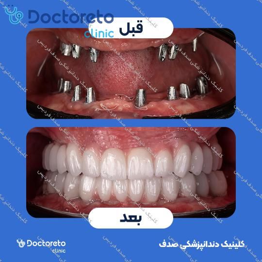 ایمپلنت core1 کره ای با روکش (هر واحد)